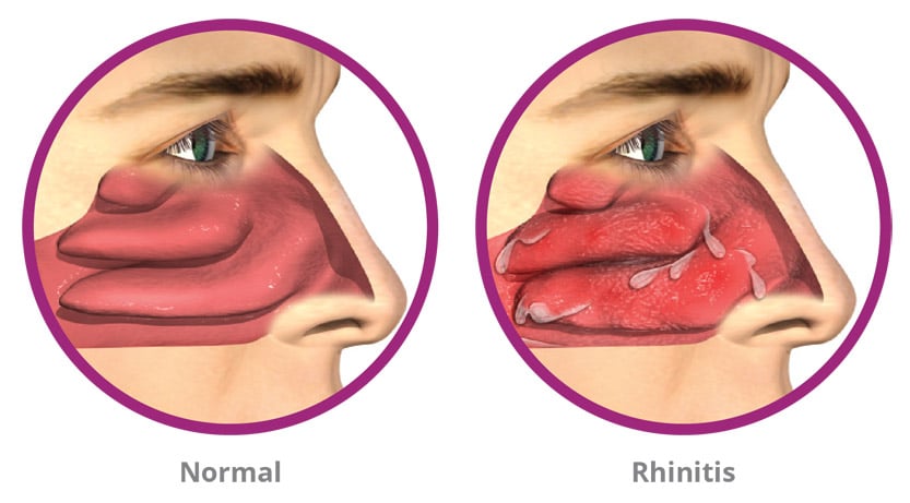 3D image showing the same person's sinus with and without rhinitis 