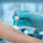 undergoing procedure of allergen skin tests in clinic