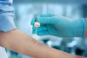 undergoing procedure of allergen skin tests in clinic