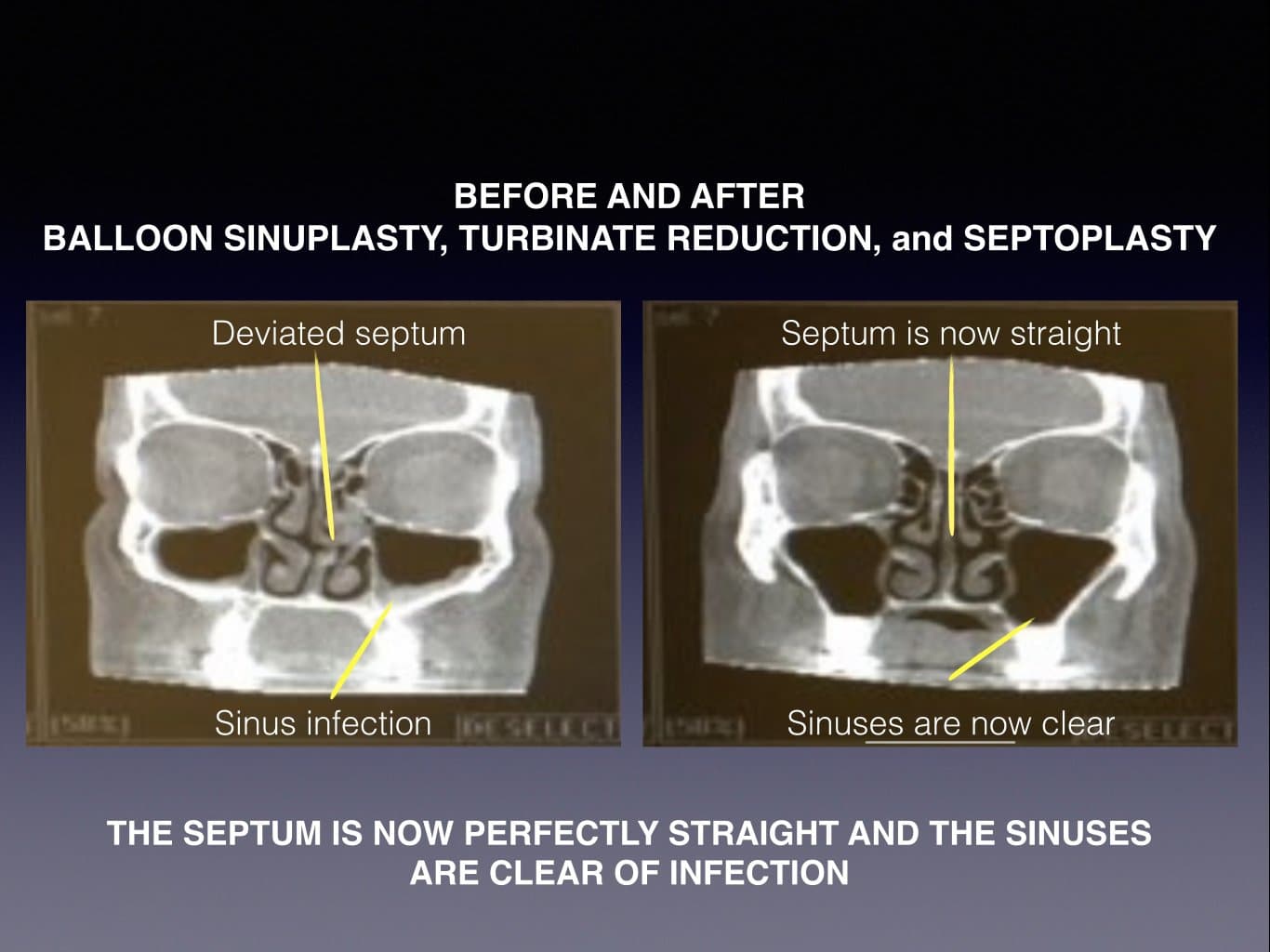 sinuplasty