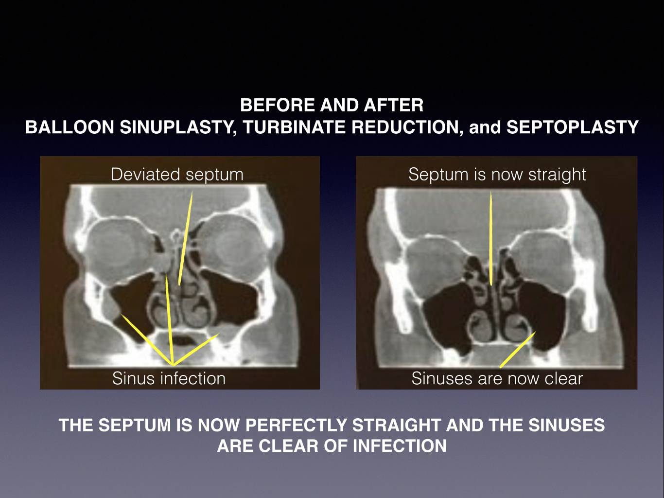 sinuplasty