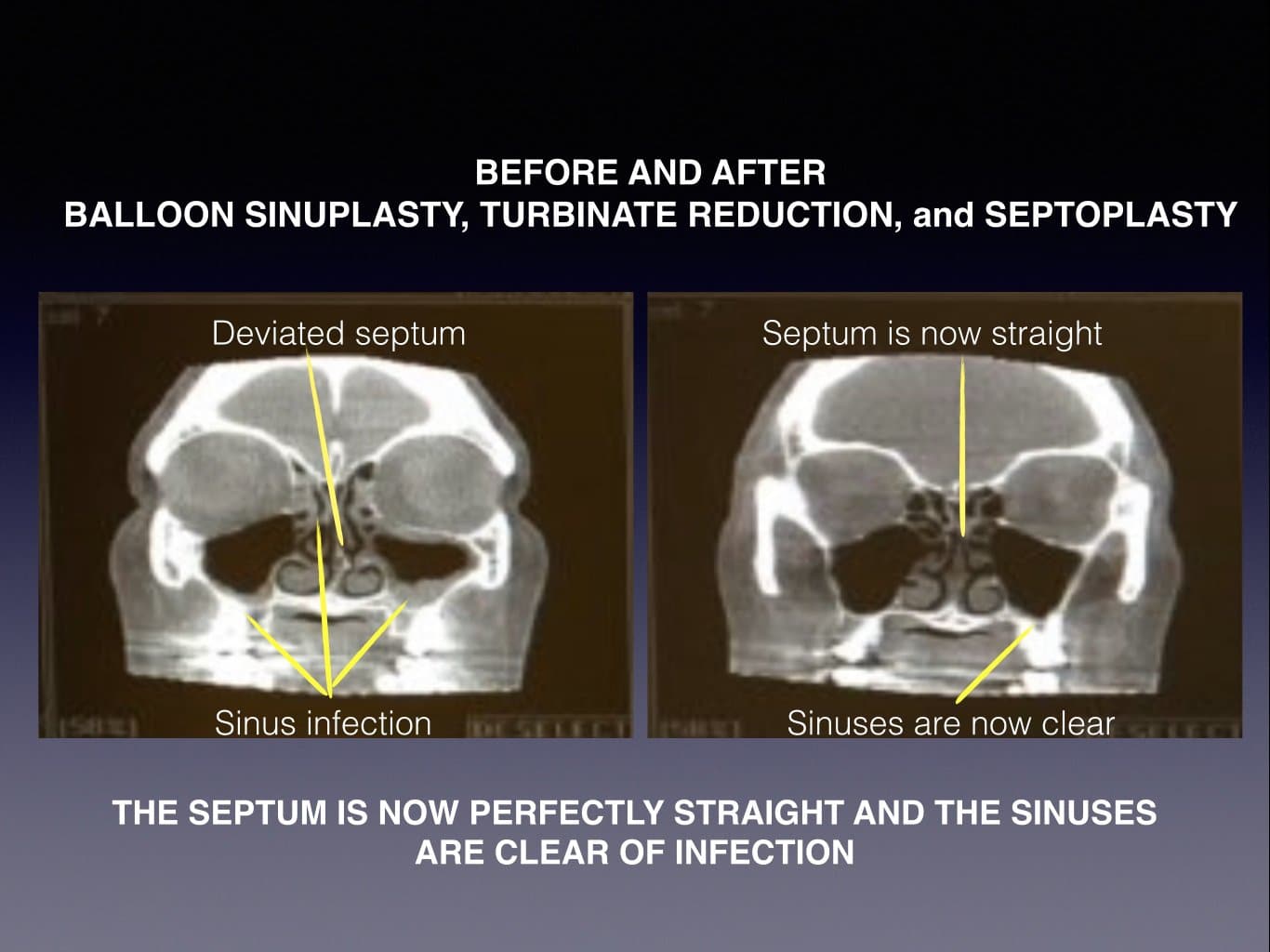 sinuplasty