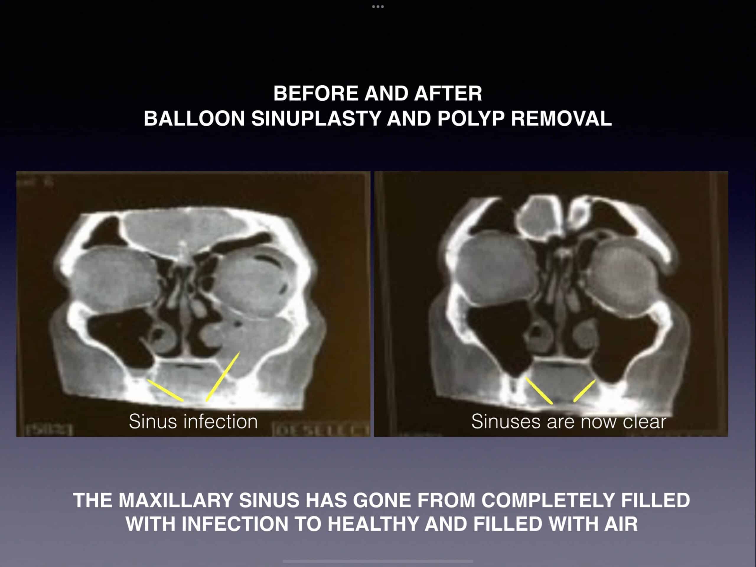 sinuplasty