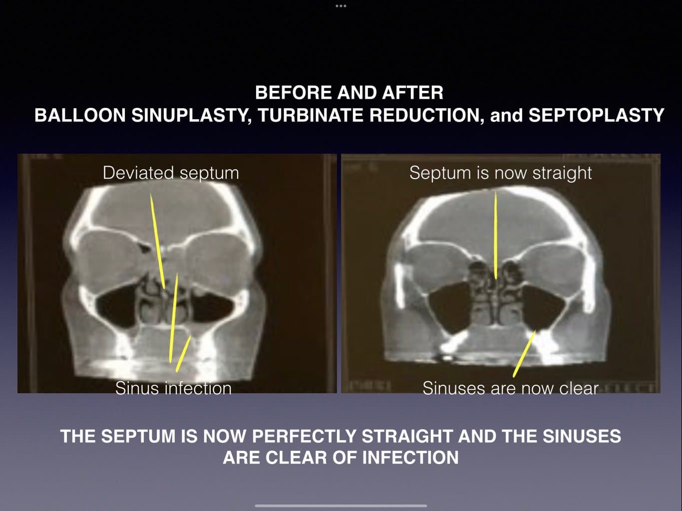 sinuplasty