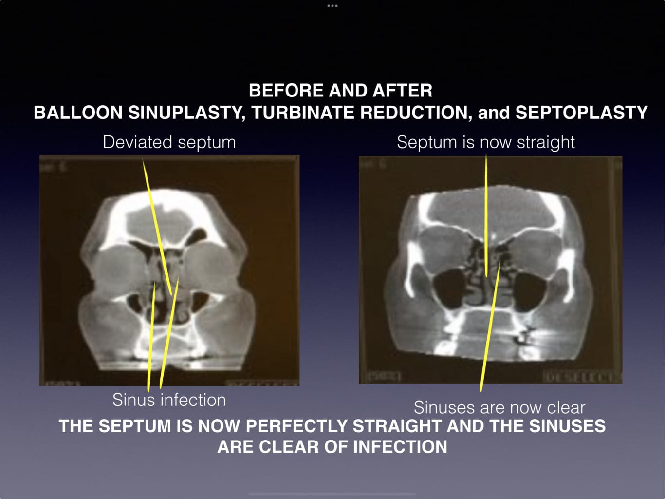 sinuplasty