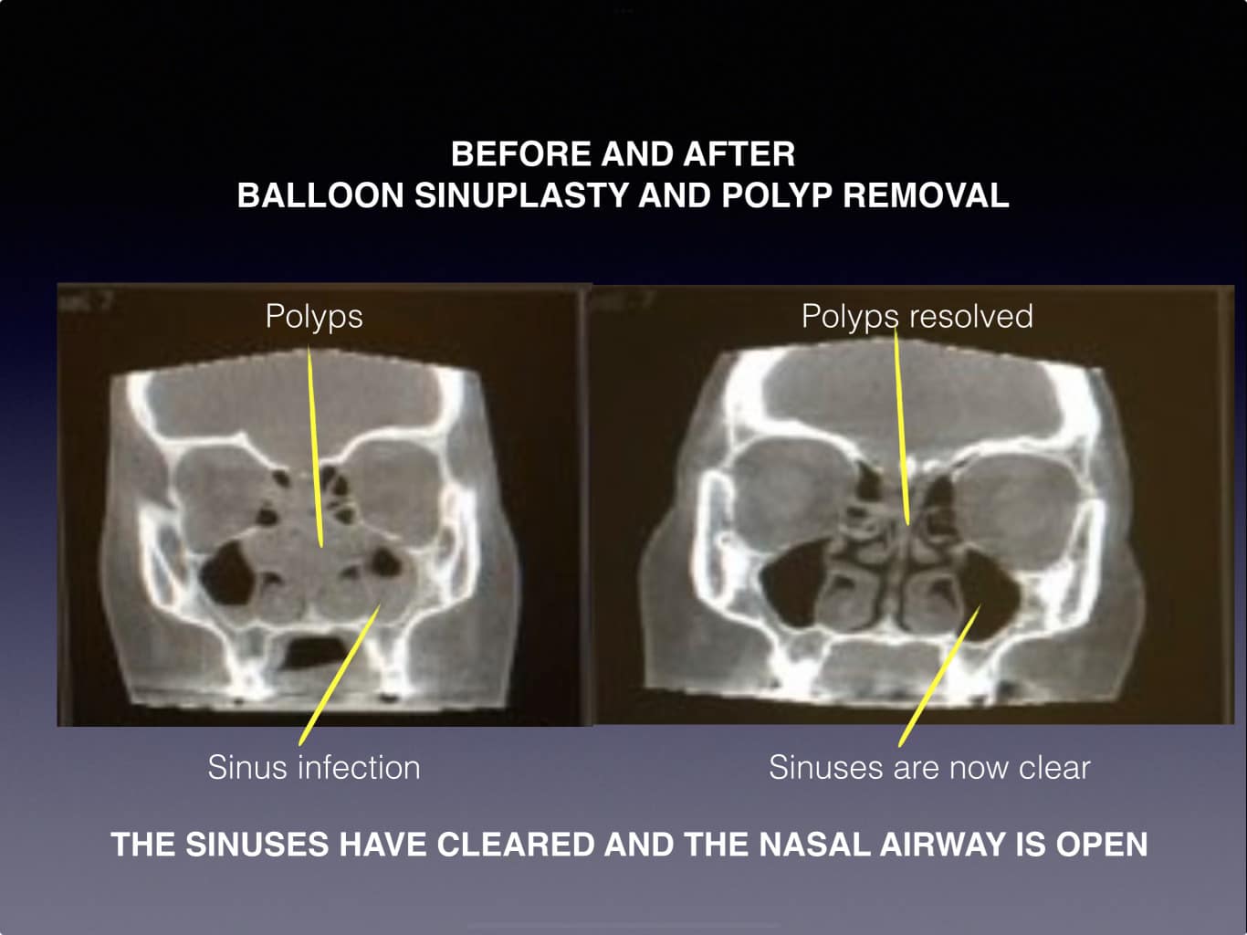 sinuplasty