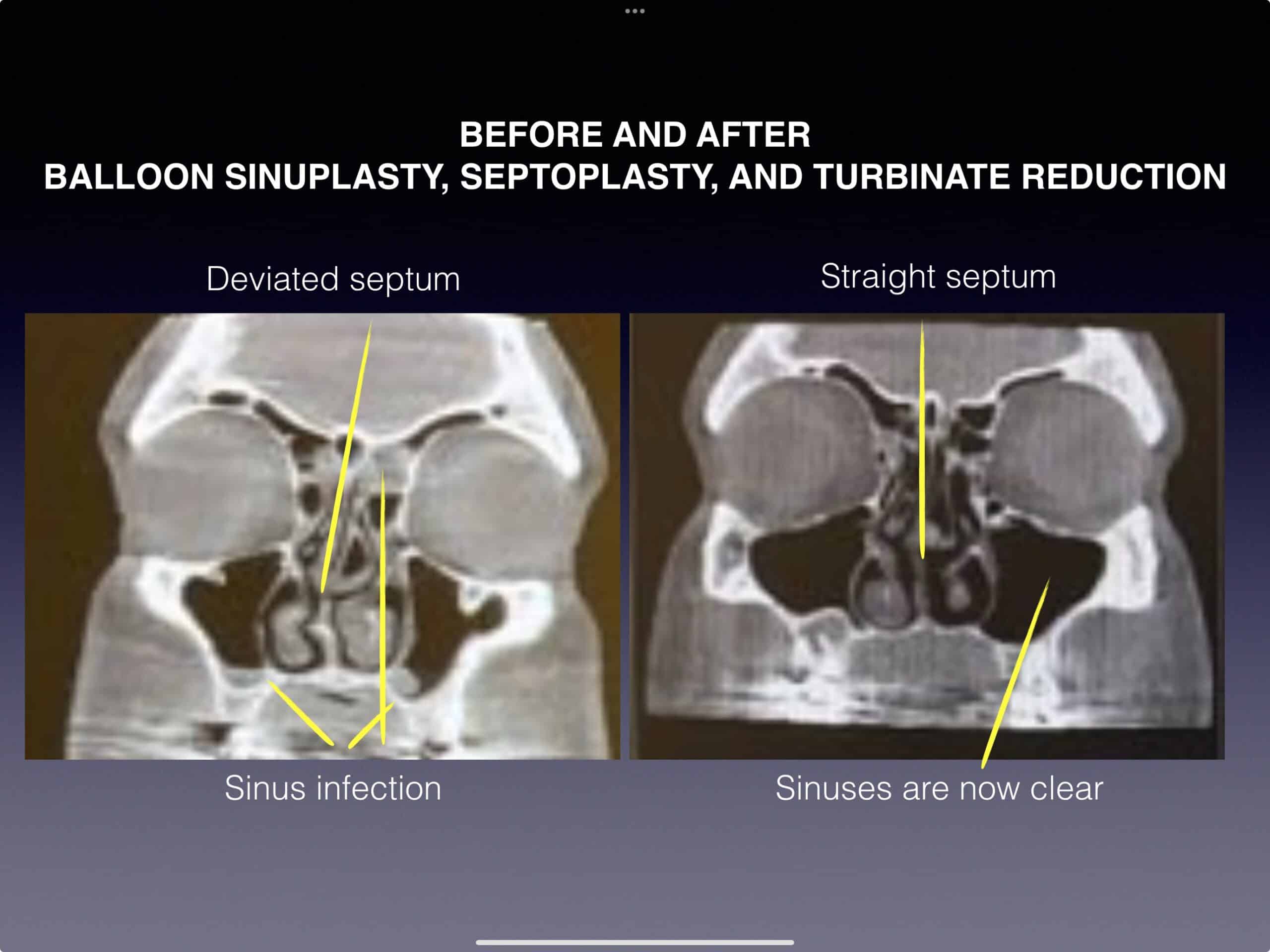 Balloon Sinuplasty, Septoplasty, and Turbinate Reduction