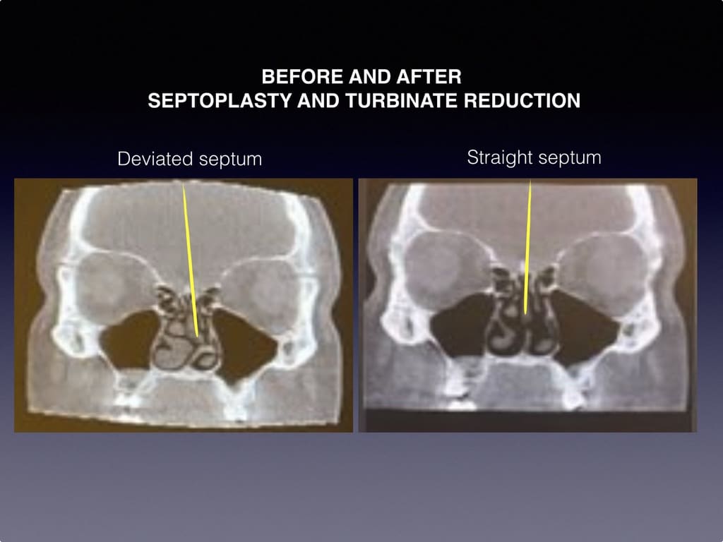 Before and After Septoplasty & Turbinate Reduction