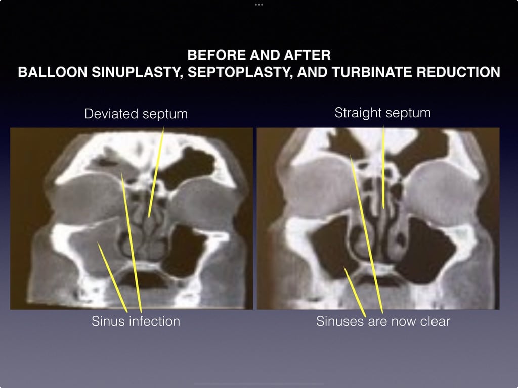 Balloon Sinuplasty, Septoplasty, and Turbinate Reduction