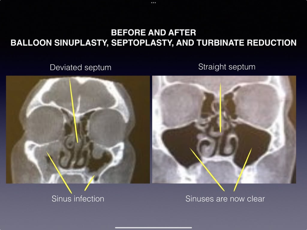 Balloon Sinuplasty, Septoplasty, and Turbinate Reduction