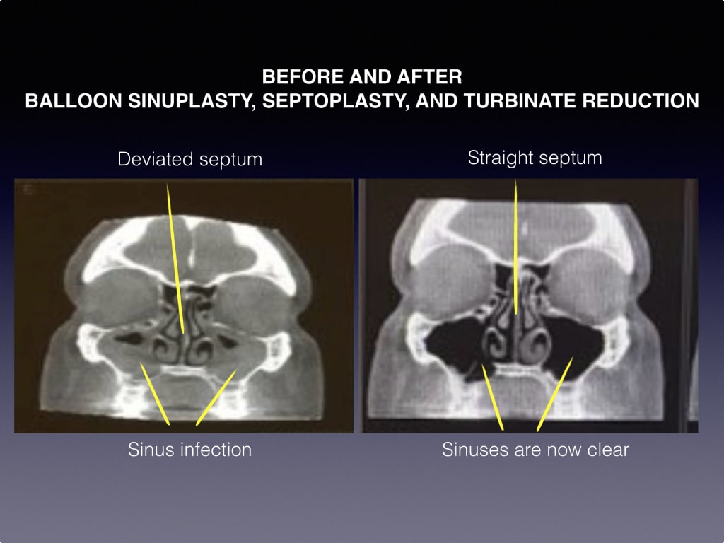 Balloon Sinuplasty, Septoplasty, and Turbinate Reduction
